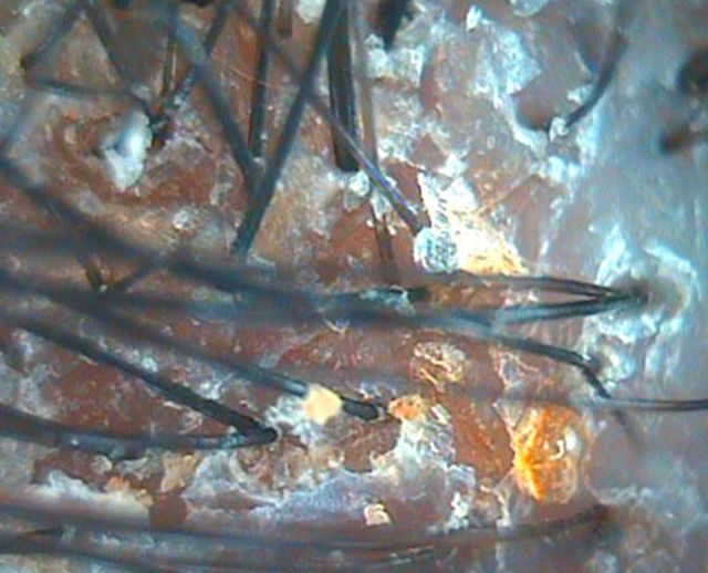 인천 부평 지루성피부염 치료 전 · 31세 여성