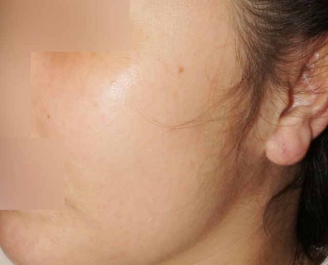 인천 부평 지루성피부염 치료 후 · 33세 여성 · 치료 기간 5개월