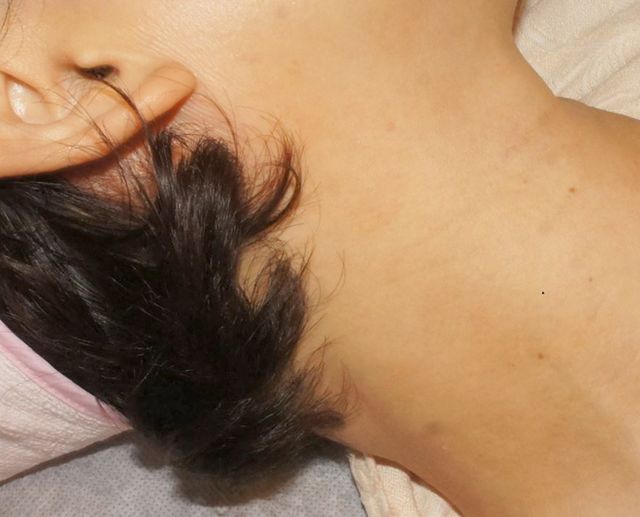 인천 부평 아토피 치료 후 · 50세 여성 · 치료 기간 6개월